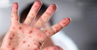 Maymun Çiçeği İçin Yeni Araştırma Sonucu